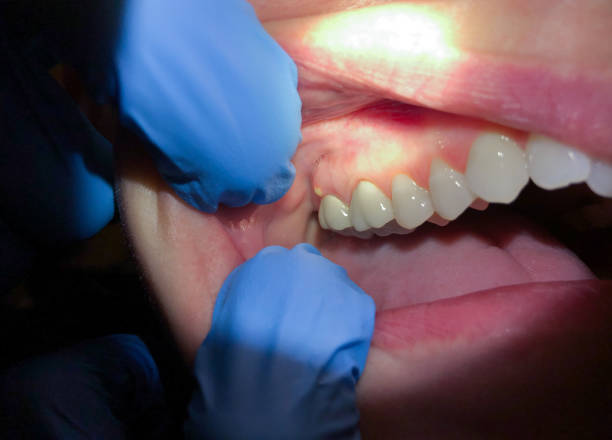 Best Emergency Denture Repair in Moreland, ID